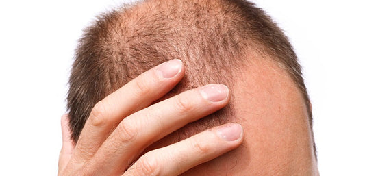 Homme appliquant un traitement anti-chute sur cuir chevelu — produits capillaires anti-chute sur laparadulac.com