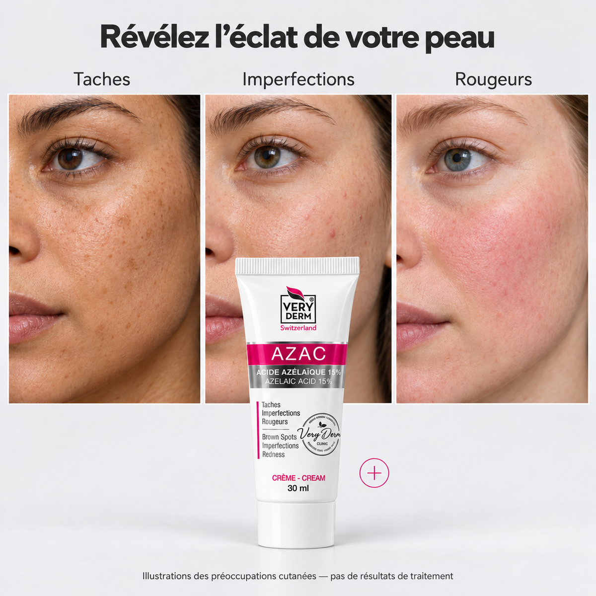 Tube de crème AZAC Very Derm 30ml à l'acide azélaïque 15% pour lutter contre les taches, imperfections et rougeurs de la peau